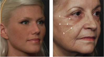 Sagging Face Correction at Perfect FACE